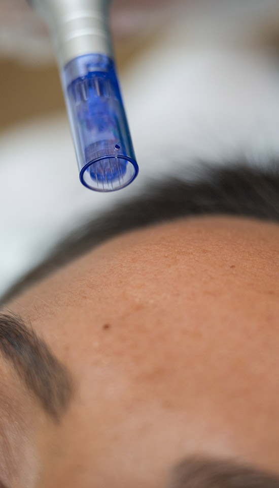 Dermapen-closeup
