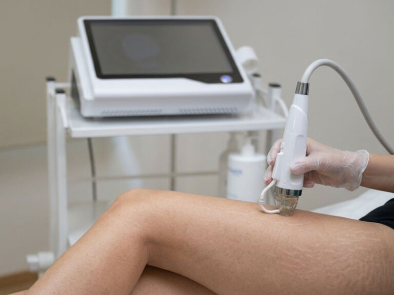 Ραγάδες Fractional RF