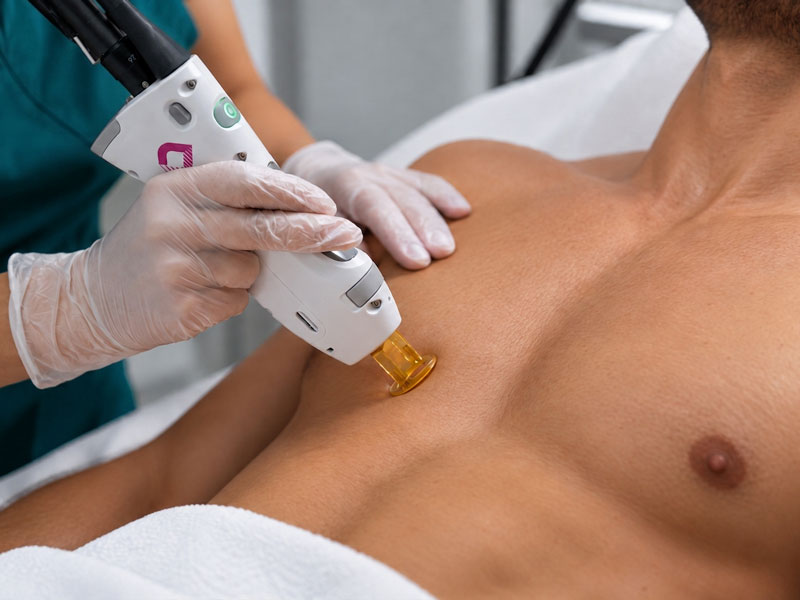 Laser_Hair_Removal_Man_1