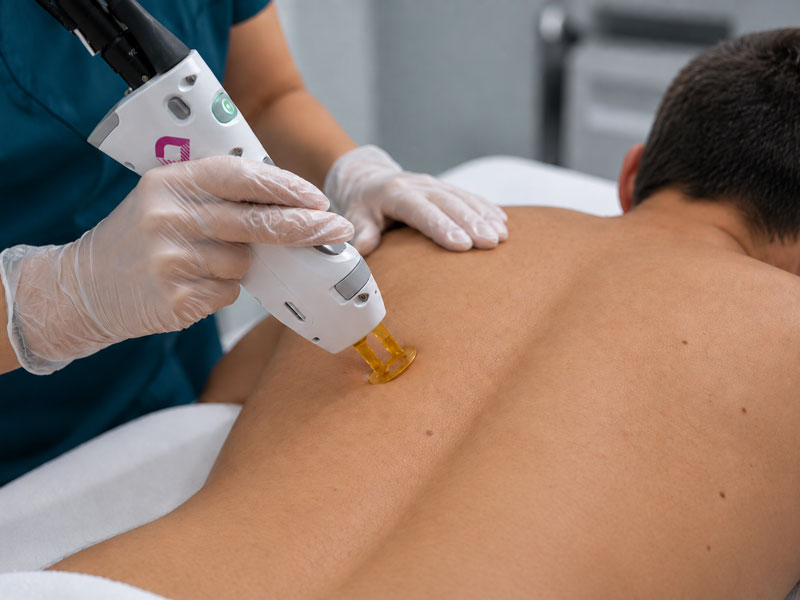 Laser_Hair_Removal_Man_2